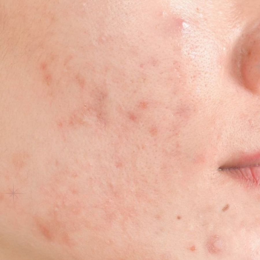 Acne e imperfecciones